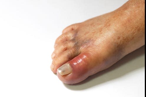 Gout used to be an affliction of royalty but is now a disease of the masses